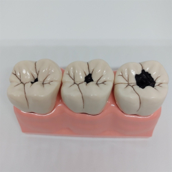 Stor Caries Studiemodel 